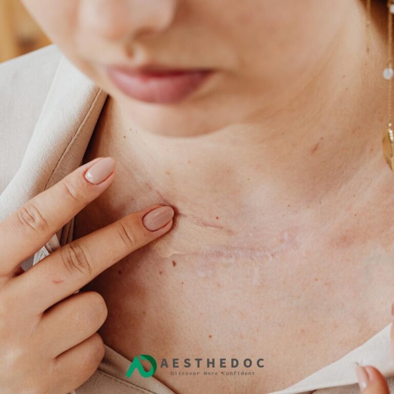 Scar & Mole Removal Treatment in Islamabad