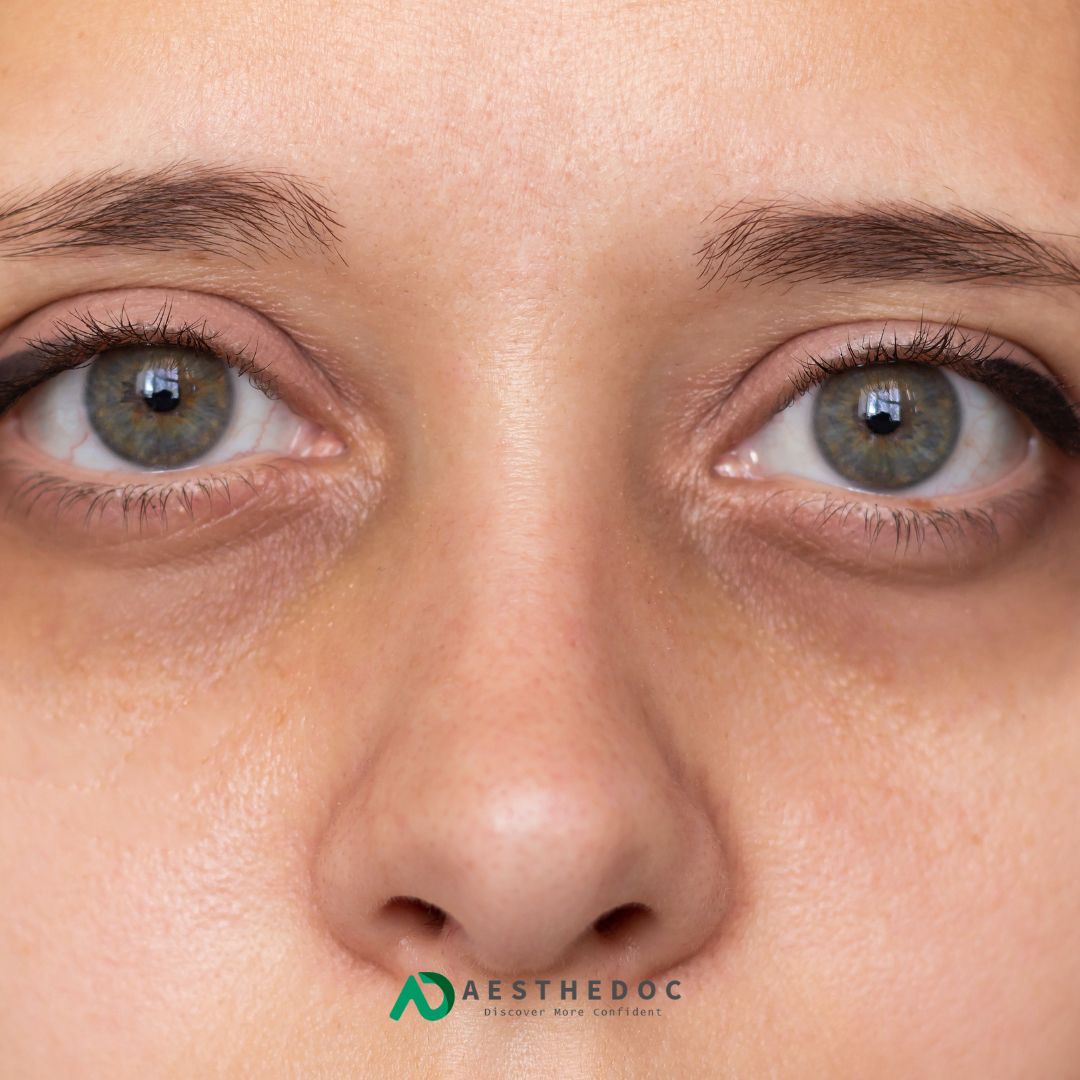 Under Eye Dark Circles Treatment in Pakistan