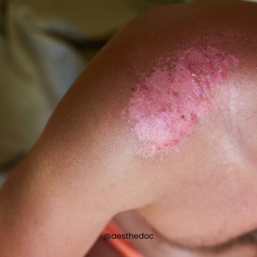 Burn Reconstruction Surgery Pakistan