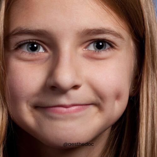 Dimple Surgery in Pakistan