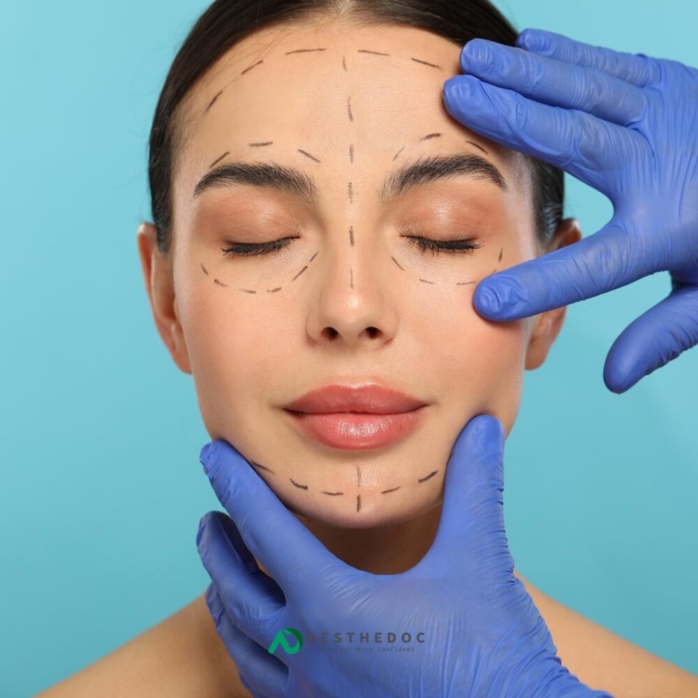 Marionette Lines Threads Treatment in Islamabad | Aesthedoc