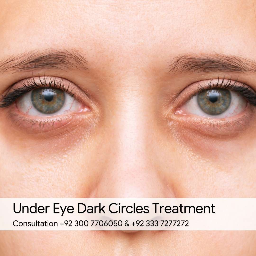 Under Eye Dark Circles Treatment