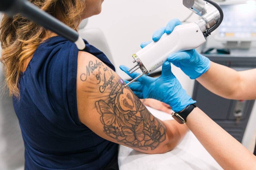 Effective Laser Tattoo Removal in Islamabad