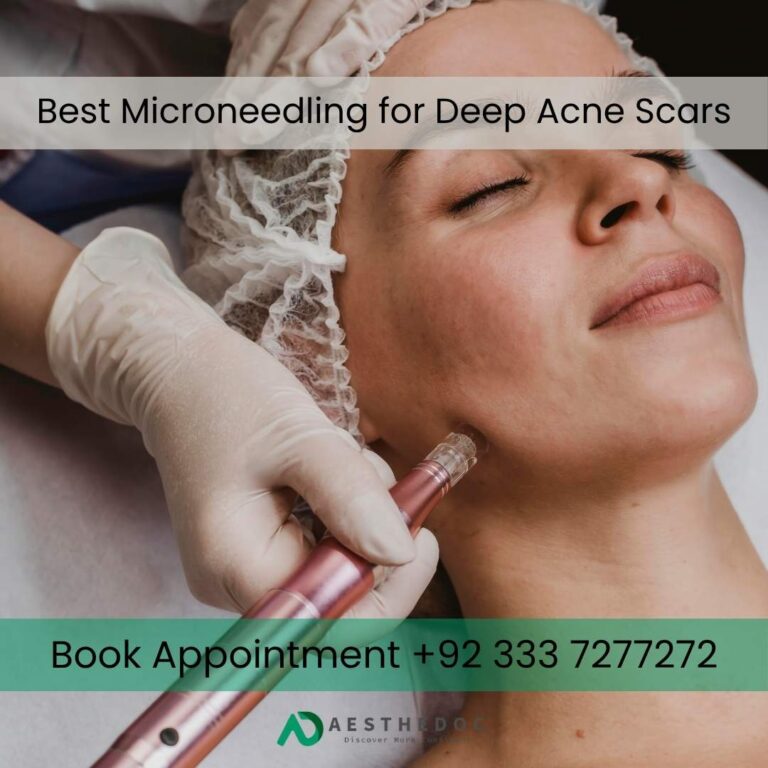 Best Microneedling for Deep Acne Scars in Islamabad Rawalpindi