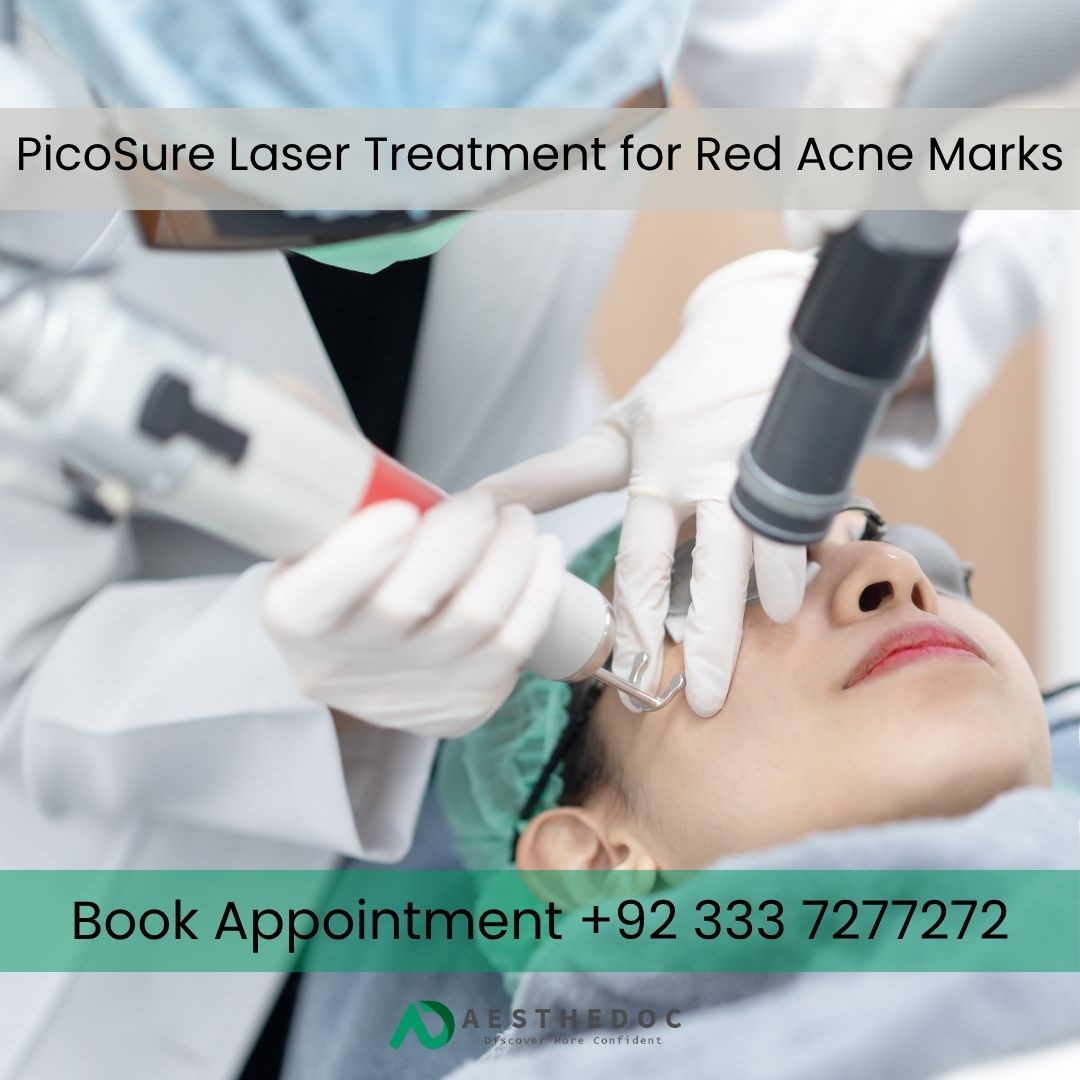 PicoSure Laser Treatment for Red Acne Marks in Islamabad and Rawalpindi