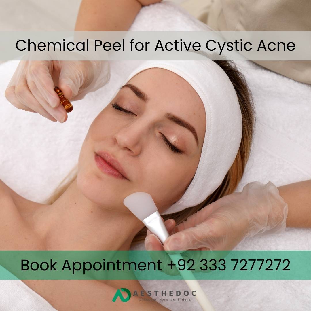 Chemical Peel for Active Cystic Acne in Islamabad | Aesthedoc Clinic