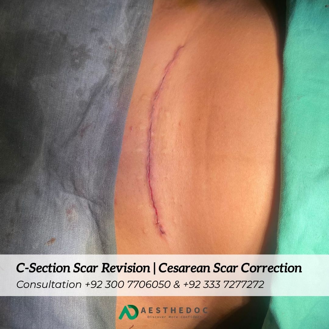 C-Section Scar Revision Cesarean Scar Correction Islamabad Rawalpindi Pakistan