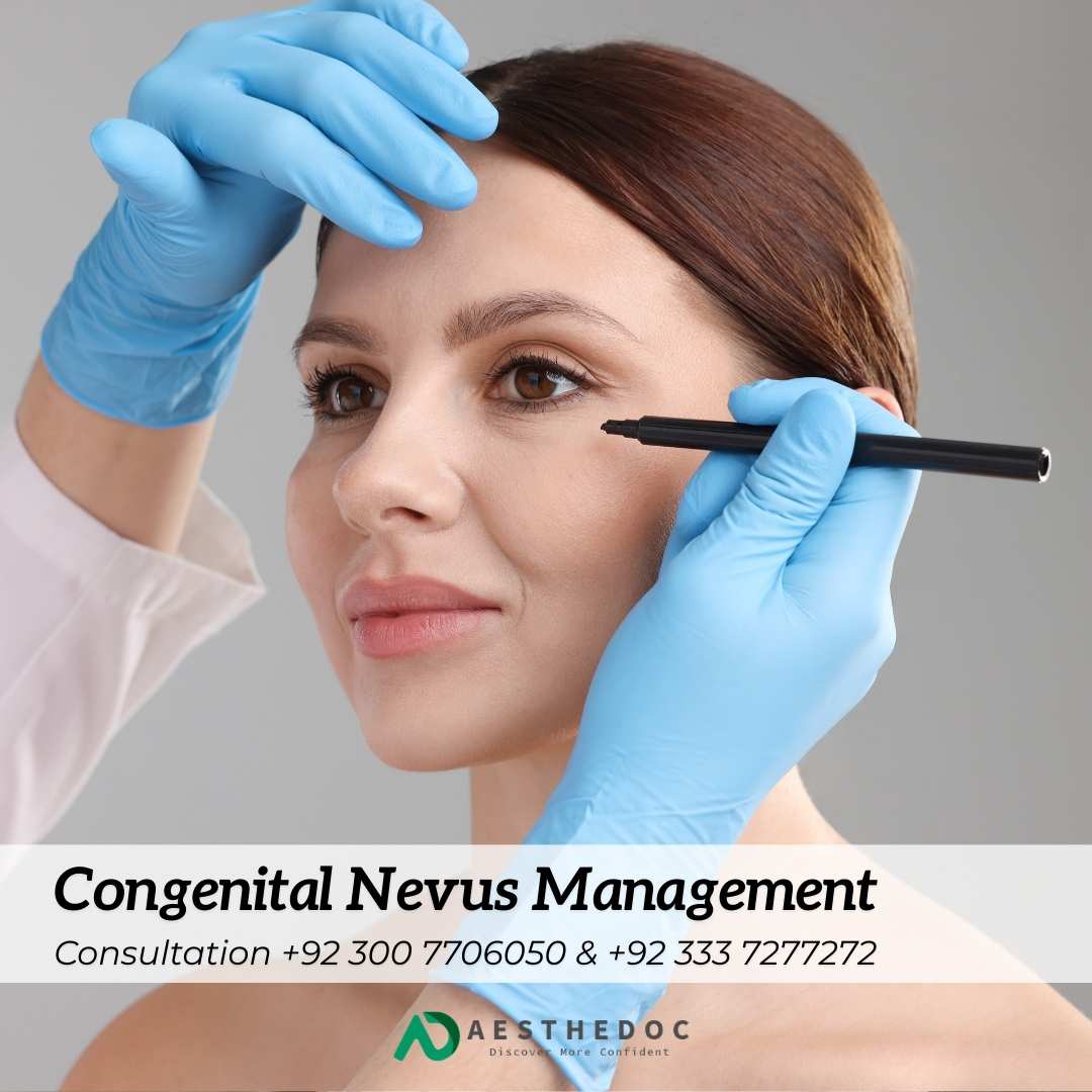 Congenital Nevus Management Islamabad Rawalpindi Pakistan