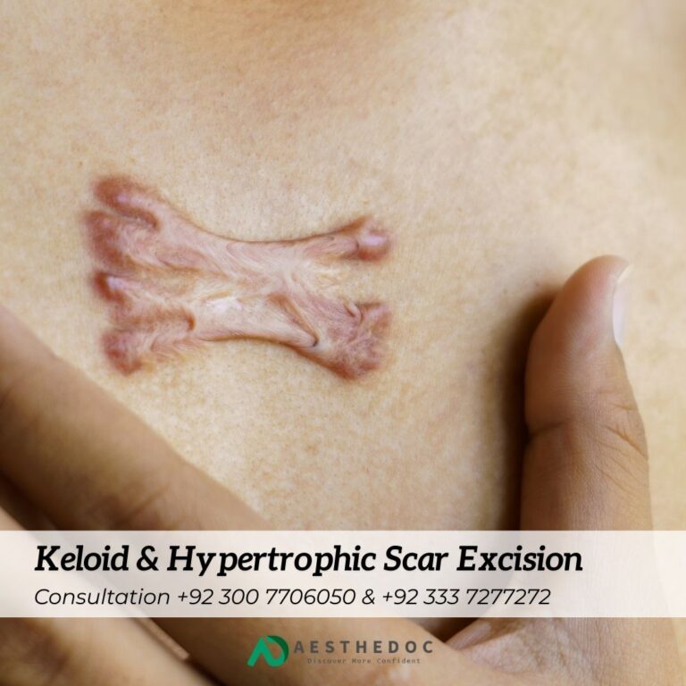 Keloid & Hypertrophic Scar Excision Rawalpindi Islamabad Pakistan