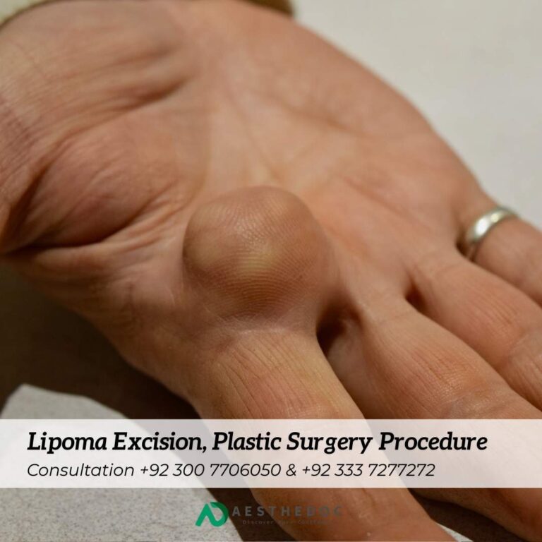 Lipoma Excision, Plastic Surgery Procedure