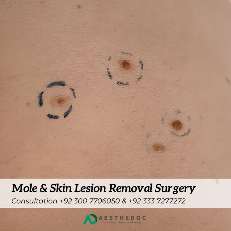Mole & Skin Lesion Removal Surgery