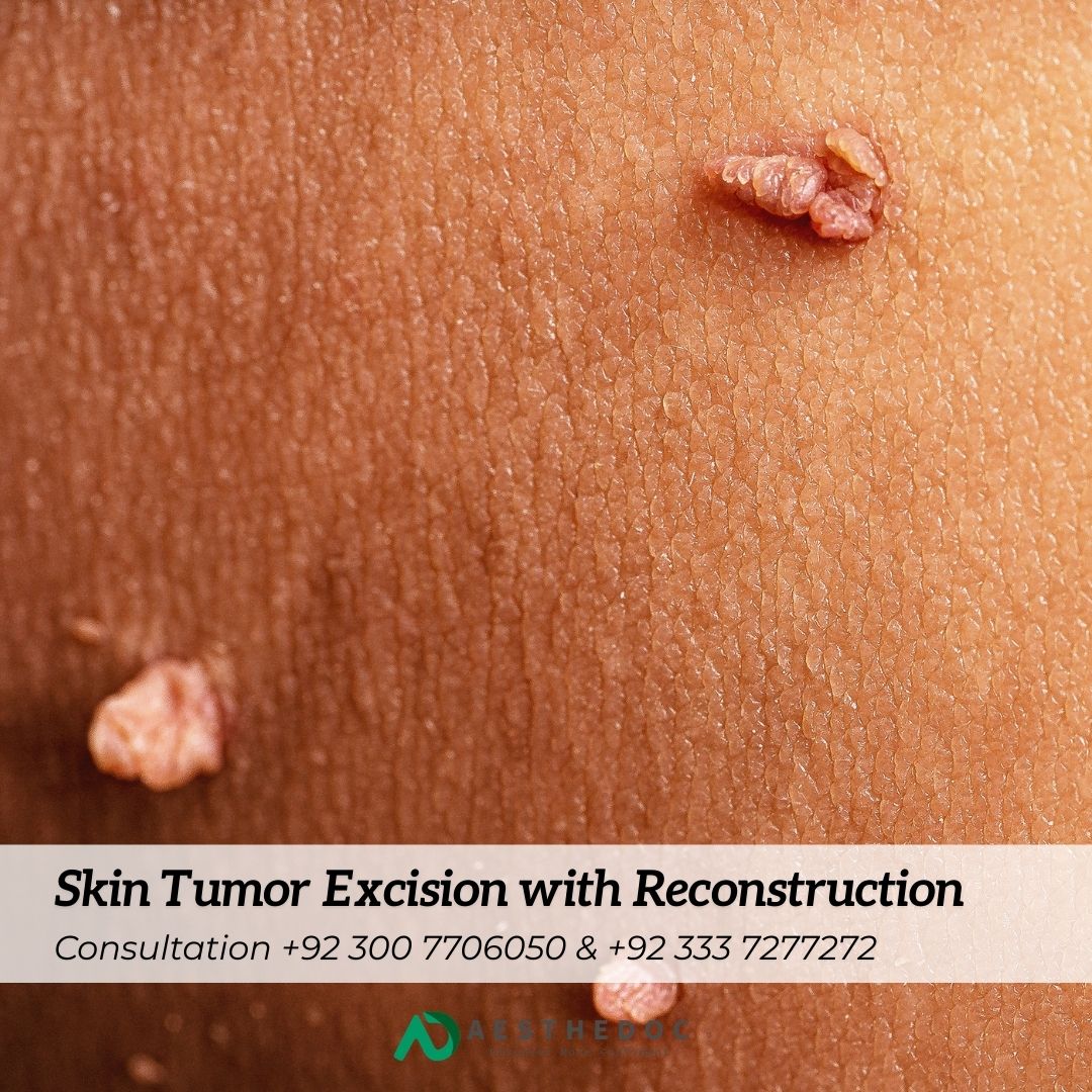 Skin Tumor Excision with Reconstruction Islamabad Rawalpindi Pakistan