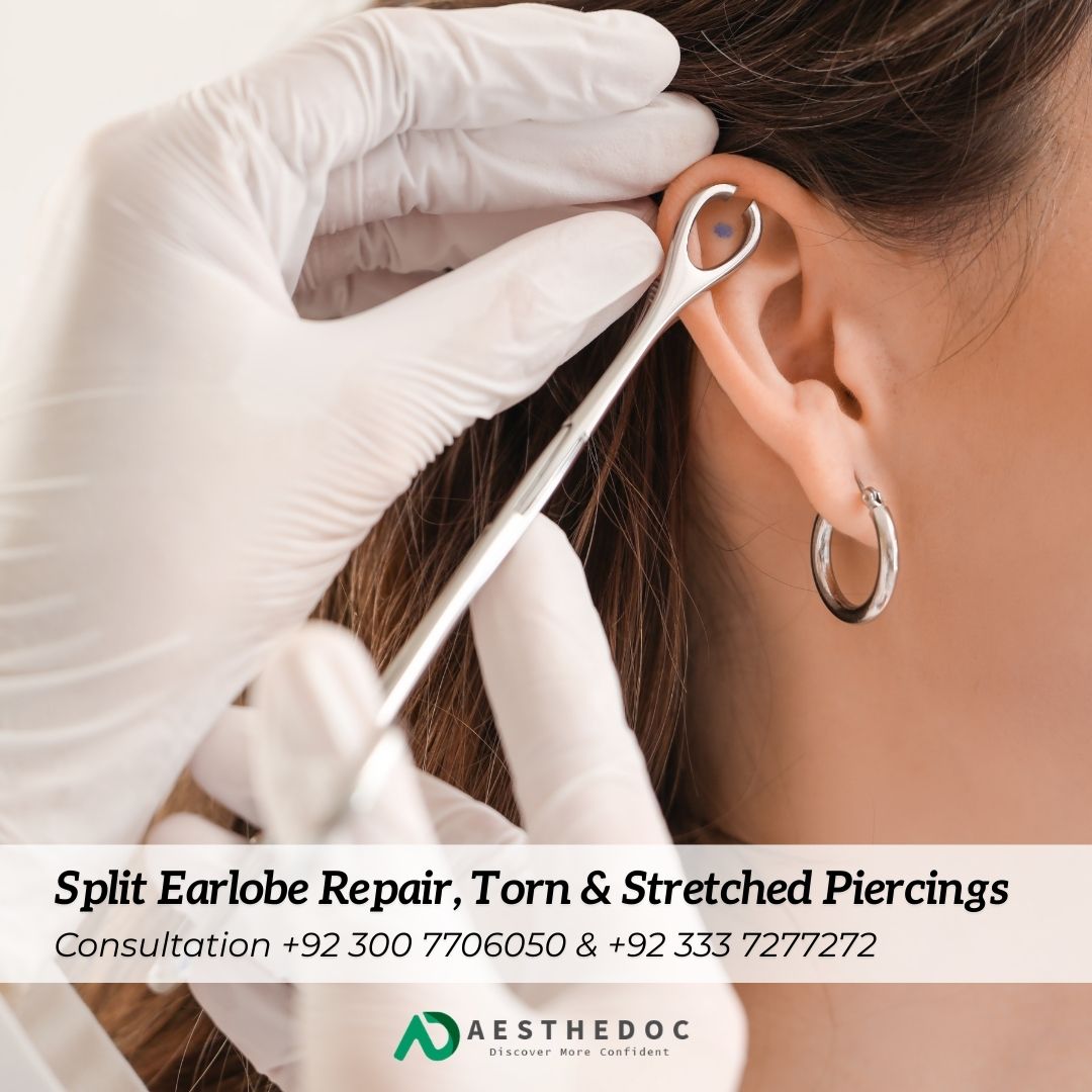 Split Earlobe Repair, Torn & Stretched Piercings