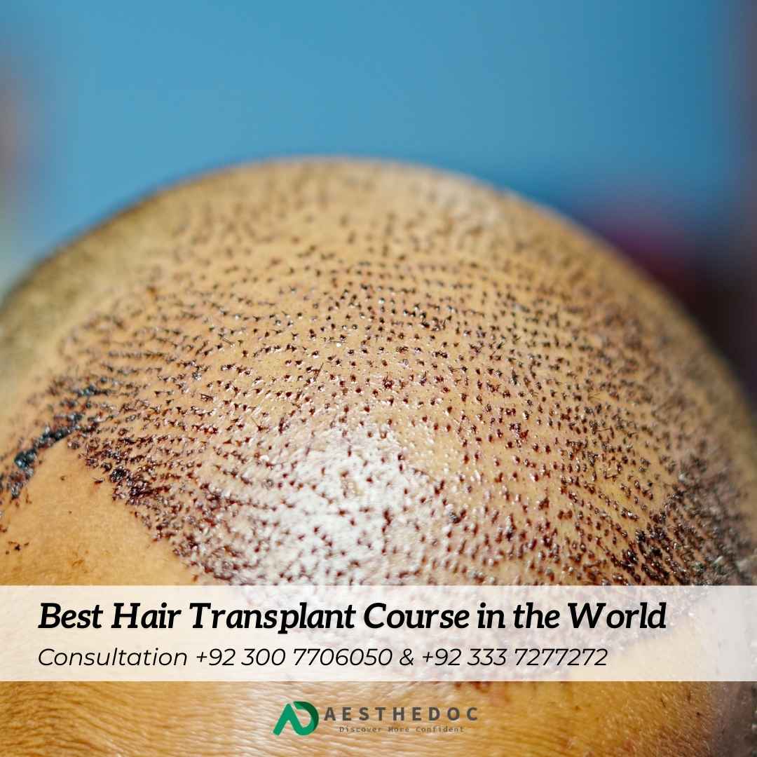 Best Hair Transplant Course in the World