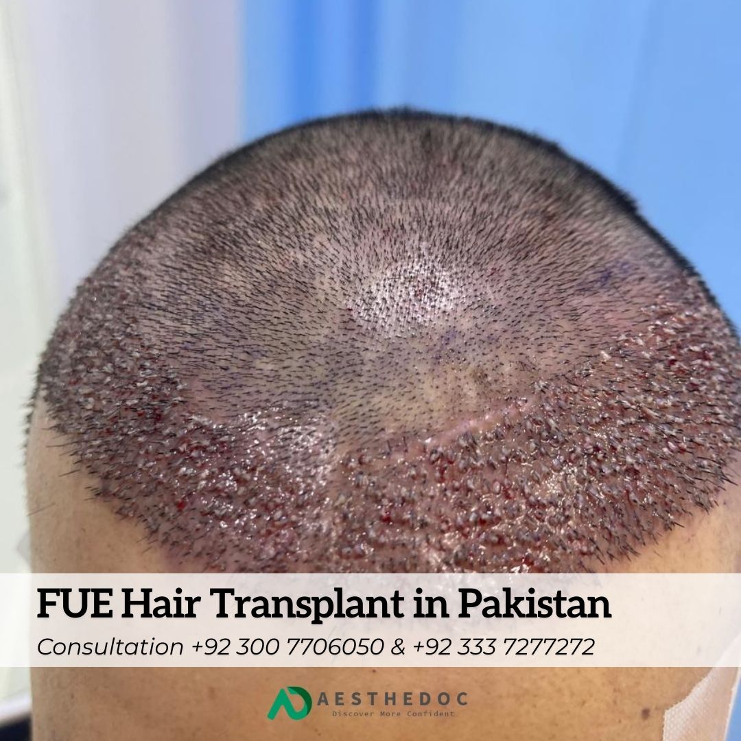 FUE Hair Transplant in Pakistan