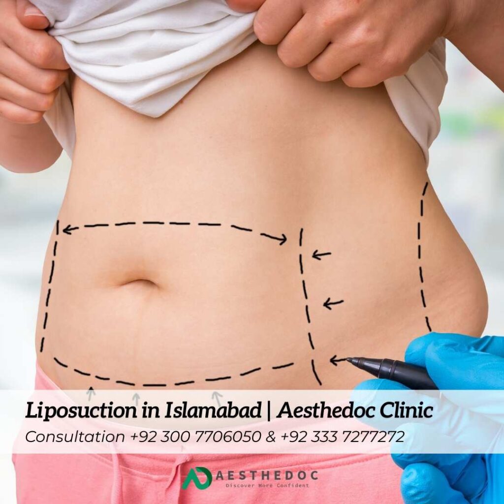 Liposuction in Islamabad | Aesthedoc Clinic