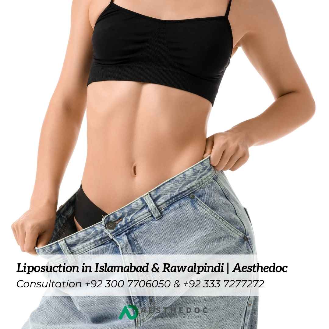 Liposuction in Islamabad & Rawalpindi