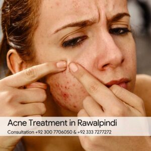 Acne Treatment in Rawalpindi
