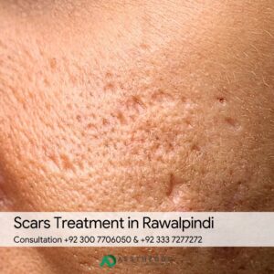 Scars Treatment in Rawalpindi